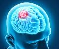 راهبرد‌های نانو ایمونوتراپی در درمان تومور‌های مغزی